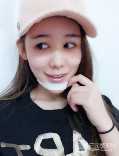 全臉自體脂肪填充，填充不飽滿還可以瘦臉_真人案例