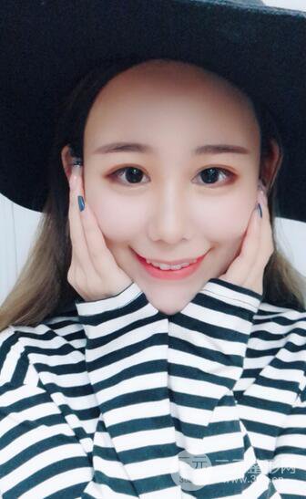 全臉自體脂肪填充，填充不飽滿還可以瘦臉_真人案例