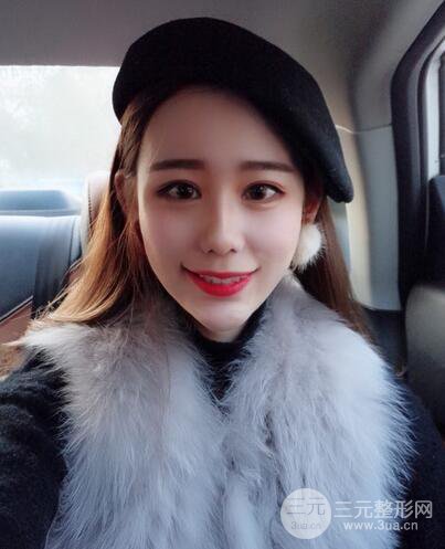 全臉自體脂肪填充，填充不飽滿還可以瘦臉_真人案例