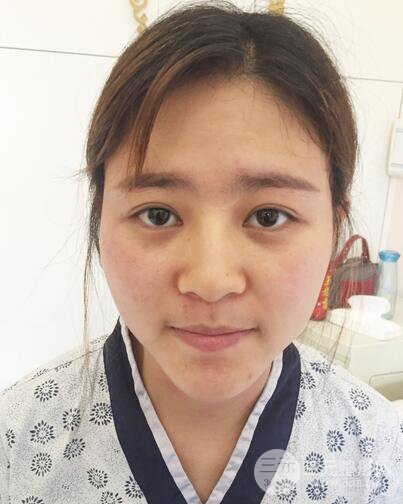 膨體隆鼻術后恢復果圖_全過程解密