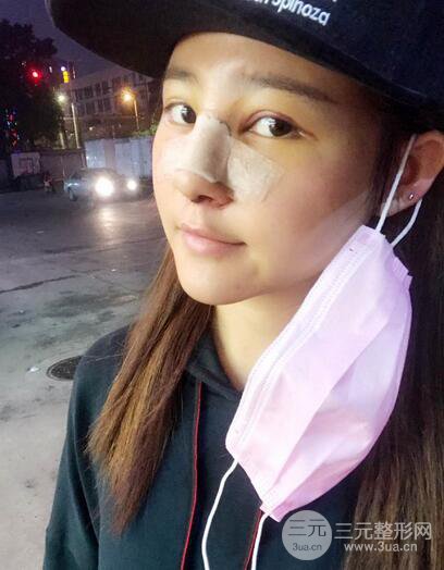 膨體隆鼻術后恢復果圖_全過程解密