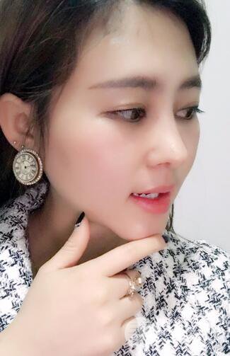 膨體隆鼻術后恢復果圖_全過程解密