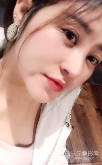 膨體隆鼻術后恢復果圖_全過程解密