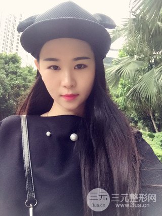 深圳全切雙眼皮修復成功案例恢復過程分享