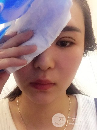 深圳全切雙眼皮修復成功案例恢復過程分享