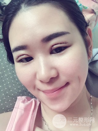 深圳全切雙眼皮修復成功案例恢復過程分享