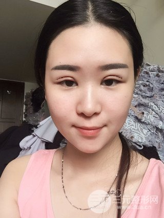 深圳全切雙眼皮修復成功案例恢復過程分享
