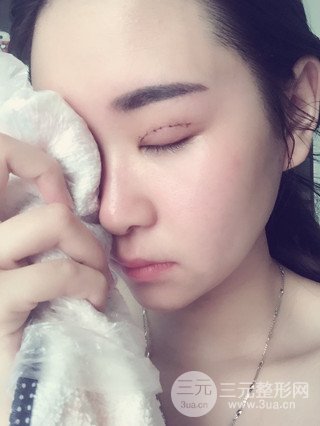 深圳全切雙眼皮修復成功案例恢復過程分享