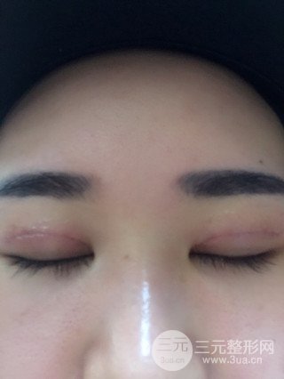 深圳全切雙眼皮修復成功案例恢復過程分享