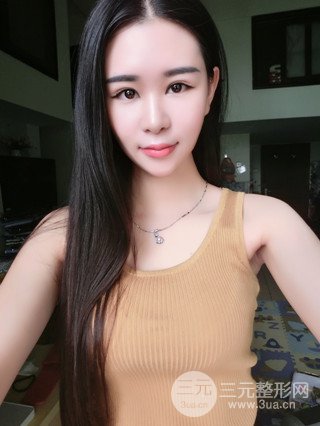 深圳全切雙眼皮修復成功案例恢復過程分享