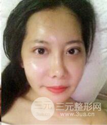 顴骨磨骨改臉型過程和恢復(fù)步驟照片（圖）