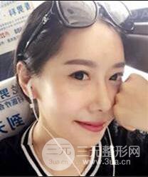 顴骨磨骨改臉型過程和恢復(fù)步驟照片（圖）