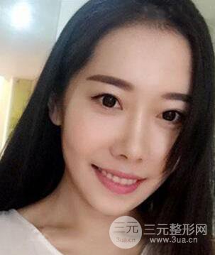 顴骨磨骨改臉型過程和恢復(fù)步驟照片（圖）