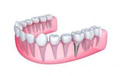 人工種植牙的優(yōu)點(diǎn)有哪些