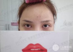 繡眉需要多少錢？繡眉后1至7天變化圖片分享~