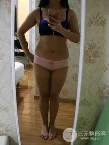 濟(jì)南腰腹吸脂案例三個(gè)月前后變化圖片分享