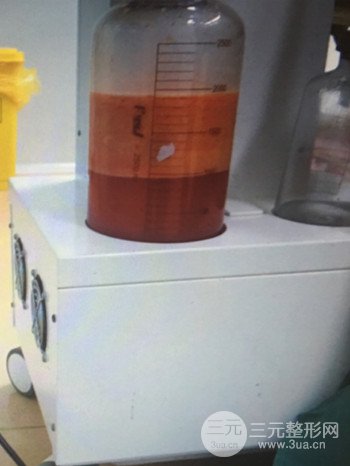 濟(jì)南腰腹吸脂案例三個(gè)月前后變化圖片分享