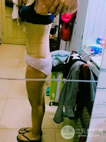 濟(jì)南腰腹吸脂案例三個(gè)月前后變化圖片分享