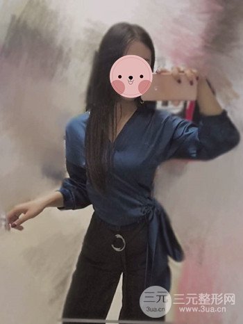 濟(jì)南腰腹吸脂案例三個(gè)月前后變化圖片分享