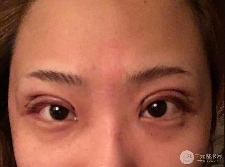 無(wú)錫菲尚徐火旺雙眼皮案例