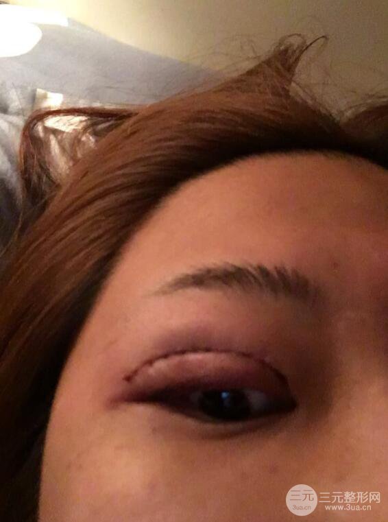 無(wú)錫菲尚徐火旺雙眼皮案例