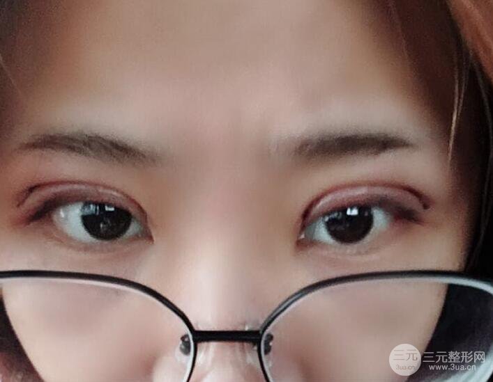 無(wú)錫菲尚徐火旺雙眼皮案例