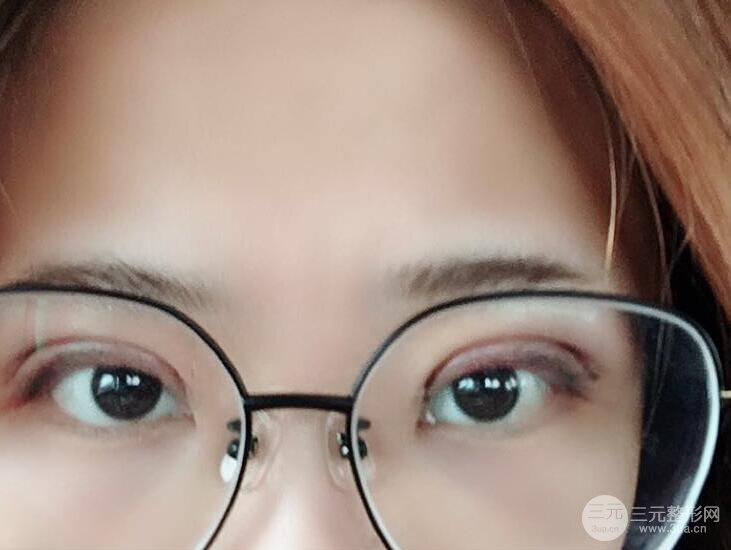 無(wú)錫菲尚徐火旺雙眼皮案例