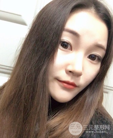 濟(jì)南硅膠假體墊下巴真人案例、下巴改變整個(gè)臉型