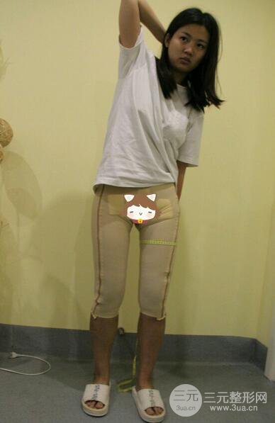 大腿吸脂后恢復(fù)過(guò)程及術(shù)后照片分享【圖片】