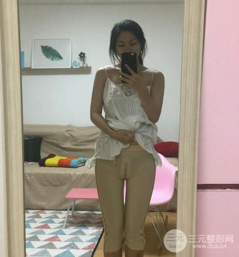 大腿吸脂后恢復(fù)過(guò)程及術(shù)后照片分享【圖片】