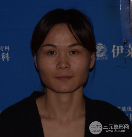 磨骨瘦臉（下頜角切除）恢復(fù)過程及前后對比照片