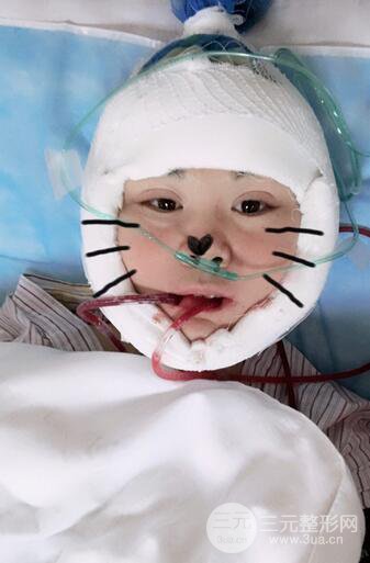 磨骨瘦臉（下頜角切除）恢復(fù)過程及前后對比照片