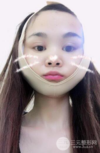 磨骨瘦臉（下頜角切除）恢復(fù)過程及前后對比照片