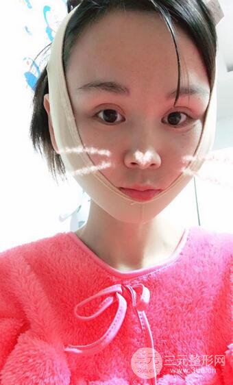 磨骨瘦臉（下頜角切除）恢復(fù)過程及前后對比照片