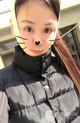 磨骨瘦臉（下頜角切除）恢復(fù)過程及前后對比照片