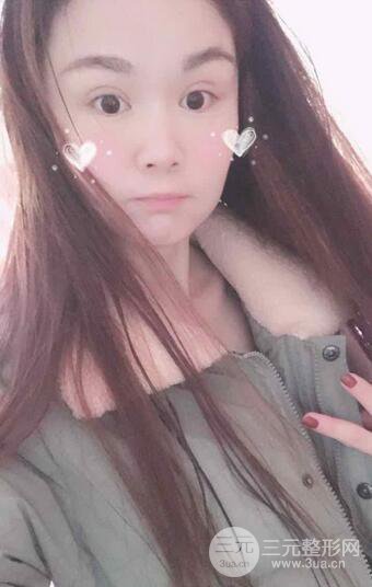 磨骨瘦臉（下頜角切除）恢復(fù)過程及前后對比照片