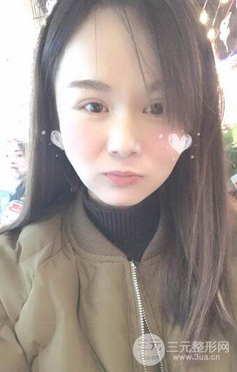 磨骨瘦臉（下頜角切除）恢復(fù)過程及前后對比照片