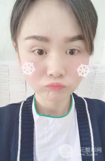 磨骨瘦臉（下頜角切除）恢復(fù)過程及前后對比照片