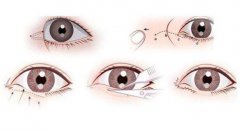 開眼角有風(fēng)險嗎