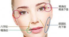 大v線(xiàn)提升面部多少錢(qián)?大V.線(xiàn)面b提升果怎么樣?