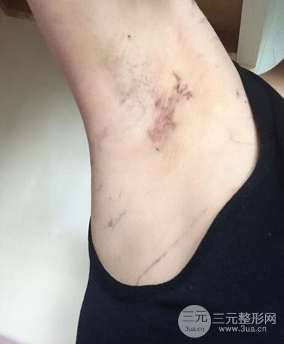 假體隆胸手術恢復記錄，豐滿大胸不是夢