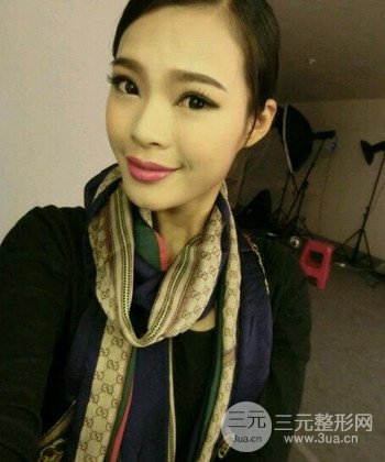 模特做隆鼻整形真實日記分享,附上恢復(fù)過程圖