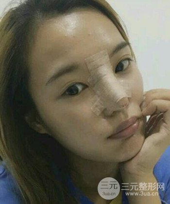 模特做隆鼻整形真實日記分享,附上恢復(fù)過程圖