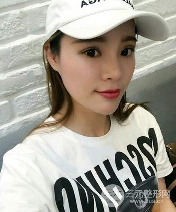 模特做隆鼻整形真實日記分享,附上恢復(fù)過程圖