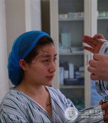 網(wǎng)絡(luò)主播做自體脂肪豐太陽穴真實案例分享，果杠杠的