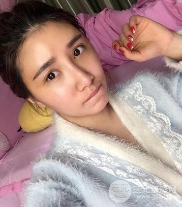 網(wǎng)絡(luò)主播做自體脂肪豐太陽穴真實案例分享，果杠杠的