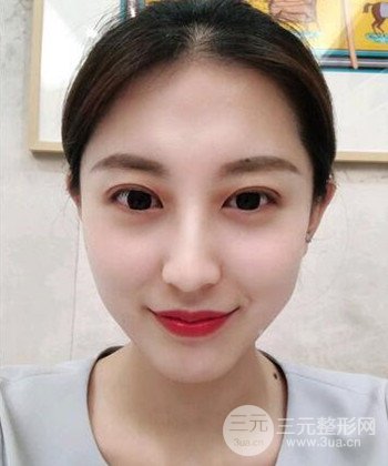 蘇州切開雙眼皮恢復(fù)果大分享，變化不止一點點