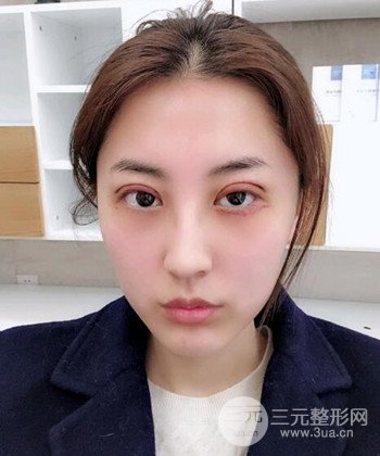 蘇州切開雙眼皮恢復(fù)果大分享，變化不止一點點