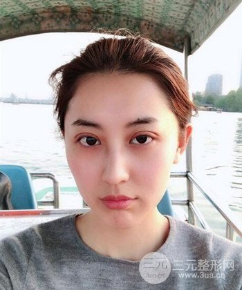 蘇州切開雙眼皮恢復(fù)果大分享，變化不止一點點