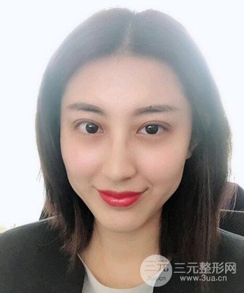 蘇州切開雙眼皮恢復(fù)果大分享，變化不止一點點